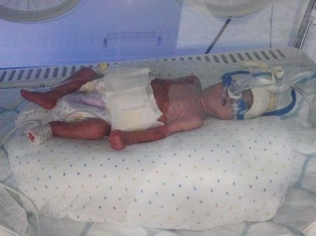 Azərbaycanda ilk: Bu uşaq xilas edildi
