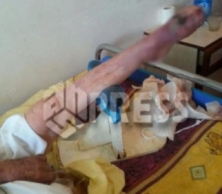 Bakıda həkimin xəstənin sağlam ayağını kəsməsinə RƏSMİ MÜNASİBƏT