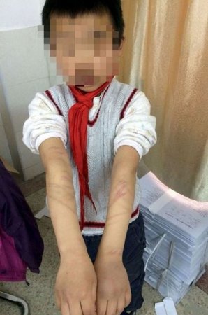 Ögey ana 9 yaşlı uşağın bədənində salamat yer qoymadı