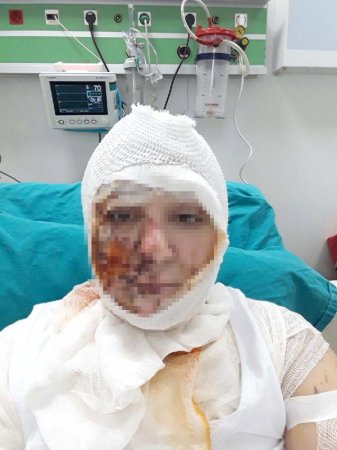 Azərbaycanlı qadına təcavüz edib, üzünə "kislota" tökən şəxs haqqında QƏRAR VERİLDİ