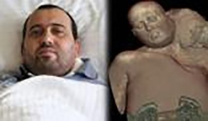 Mikayıl Mustafayevin boynundakı 8 kiloluq bədheybət Türkiyədə kəsildi Mikayıl Mustafayevin boynundakı 8 kiloluq bədheybət Türkiyədə kəsildi