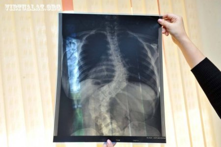 “Həkimə yalvarmışam ki, müalicəni yarımçıq saxlamasın”
