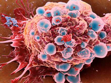 Xərçəng epidemiyasının əsas səbəbi açıqlandı
