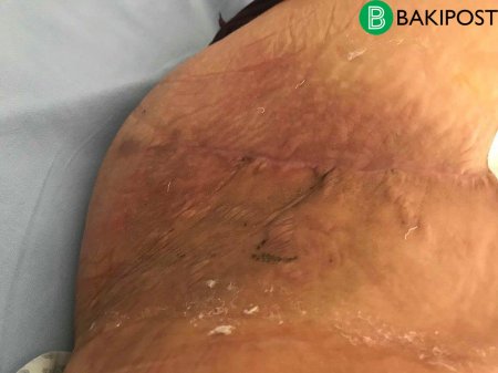 Baş həkimin əməliyyat etdiyi qadın dəhşətli durumda: İnfeksiya ətini yeyir